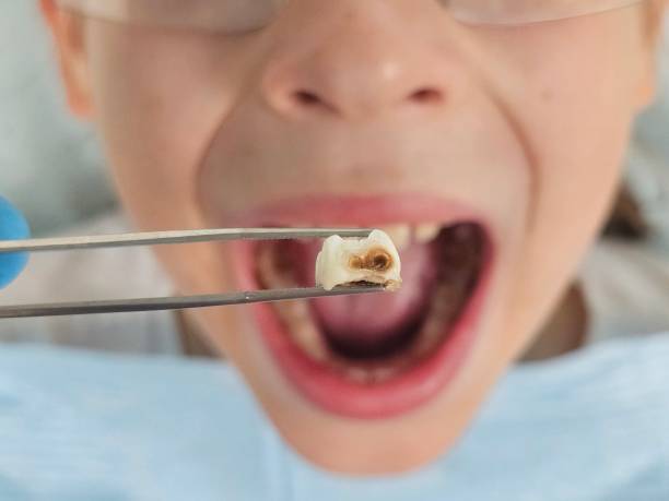 Best Knocked-Out Tooth (Avulsed Tooth) Treatment in Cherryville, NC